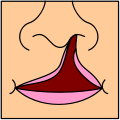 Unilateral Cleft Lip